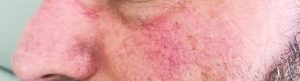 rosacea