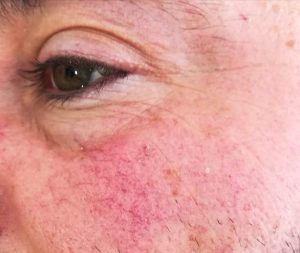 rosacea